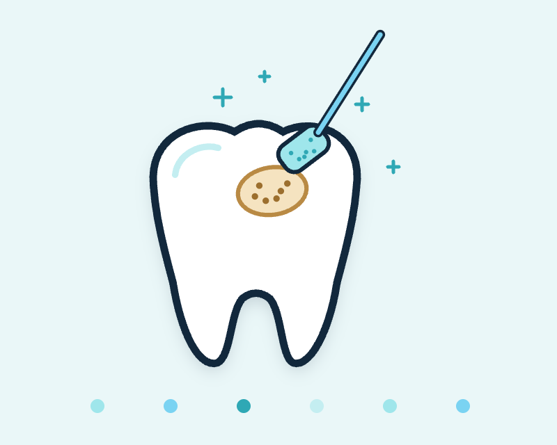 Illustration of a tooth with early decay being treated by a Curodont sponge applicator